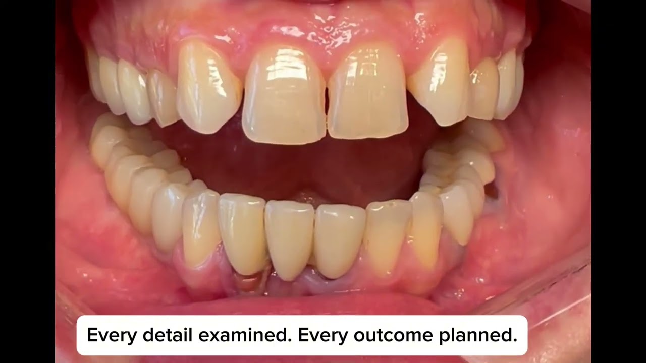 Congenitally Missing Lateral Teeth. Some smiles require more than treatment - they require vision.