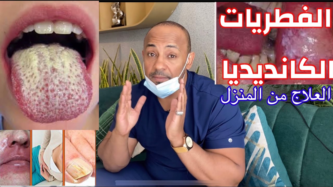 ١- اقتل كل الفطريات الي في جسم من المنزل ,اعراض و علاج الكانديديا# علاج الكانديديا بالاعشاب