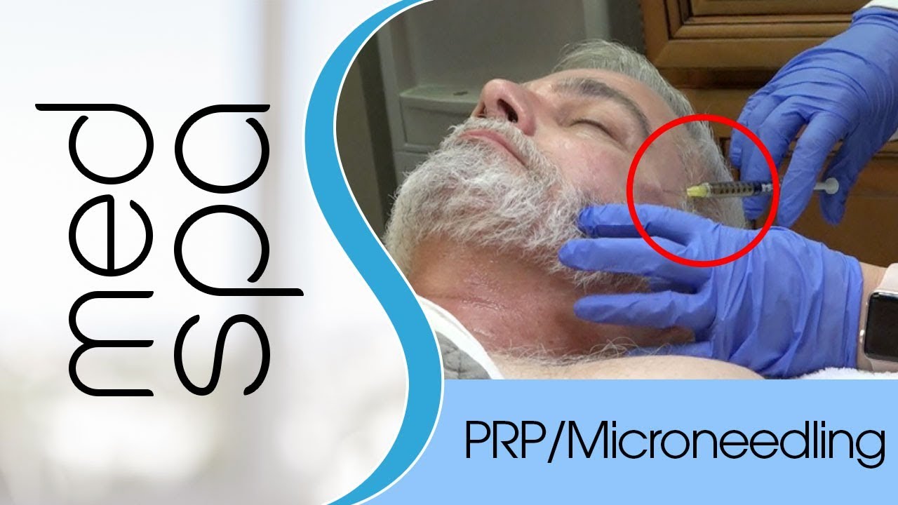 Non-surgical facelift: PRP Injections and Microneedling