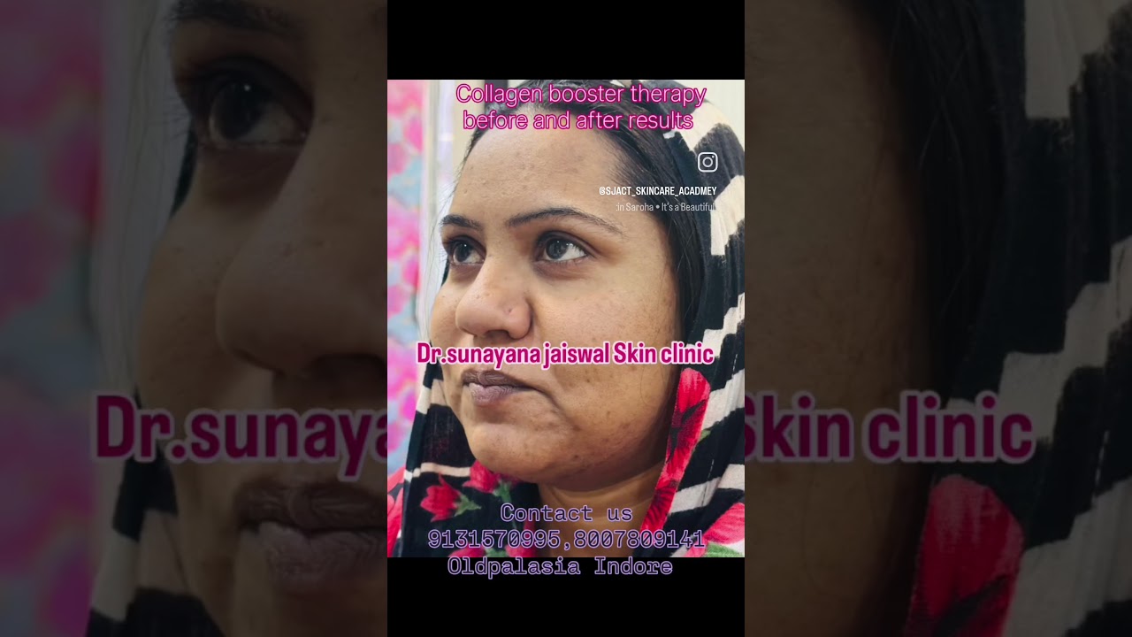 collagen booster therapy book your appointment contact us 9131570995,8007809141 Oldpalasia Indore