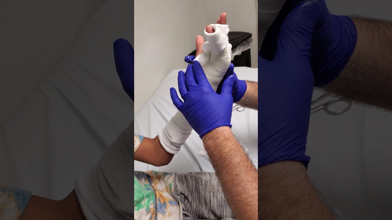 How to make an Ulnar Gutter Cast (fiberglass)