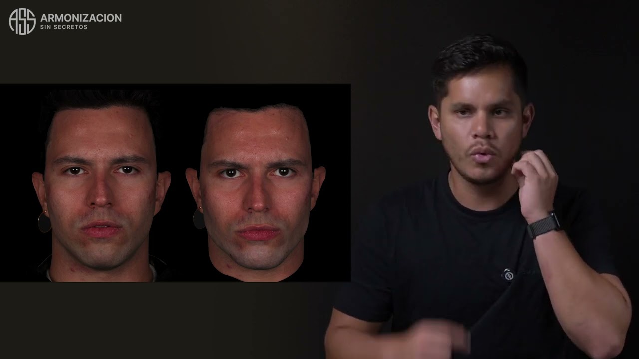 Relleno de Mandibula _Caso Clínico