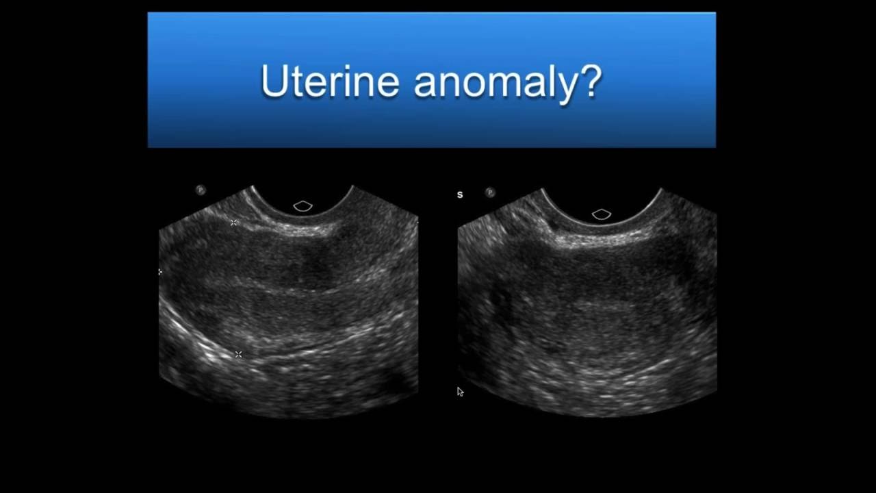 AIUM Webinar: Problem Solving with 3D Sonography of the Uterus and Adnexa