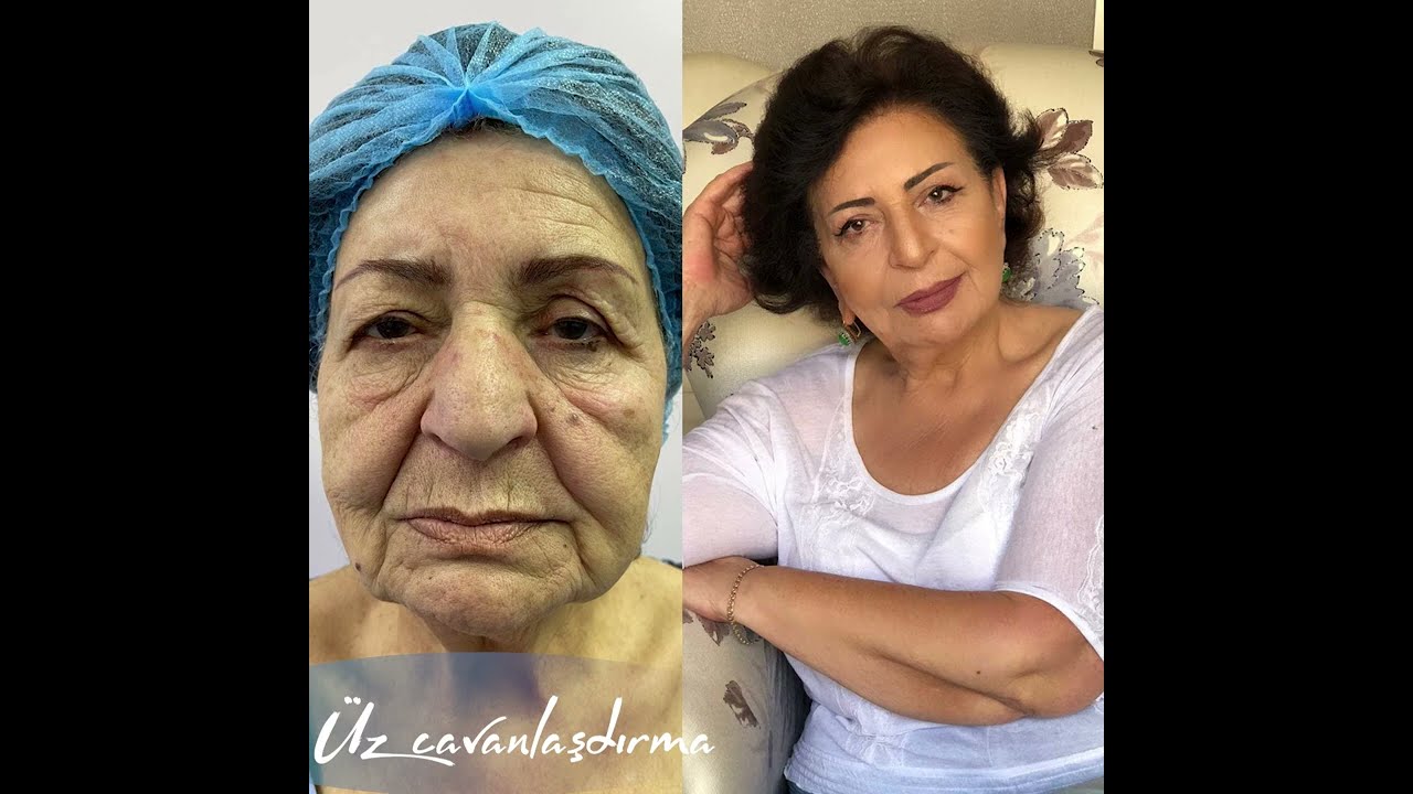Plastik, estetik cərrah Sevinc Heydərova kök hüceyrə prosedurları #kök#huceyre