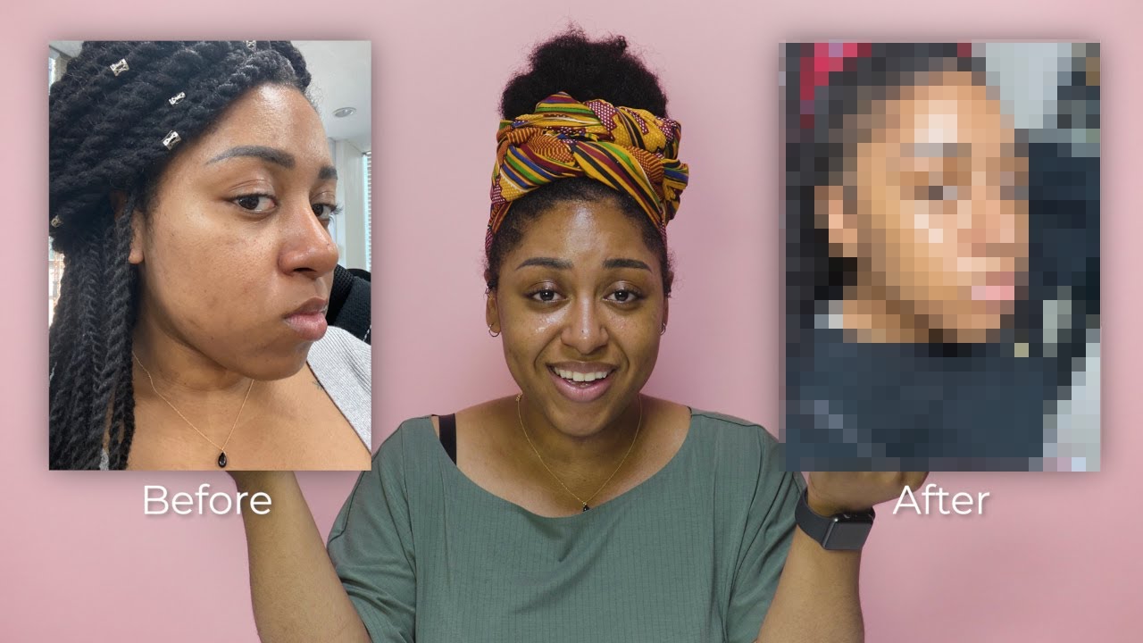 Laser Treatment for Pore Tightening and Hyperpigmentation