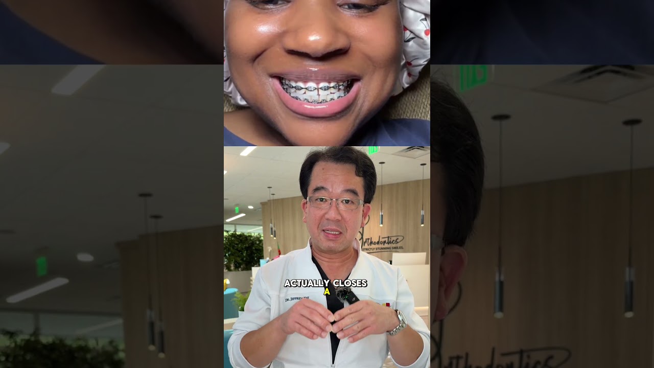 The power of Power Chains! #orthodontist #braces #teeth #straightteeth #powerchains #orthotips