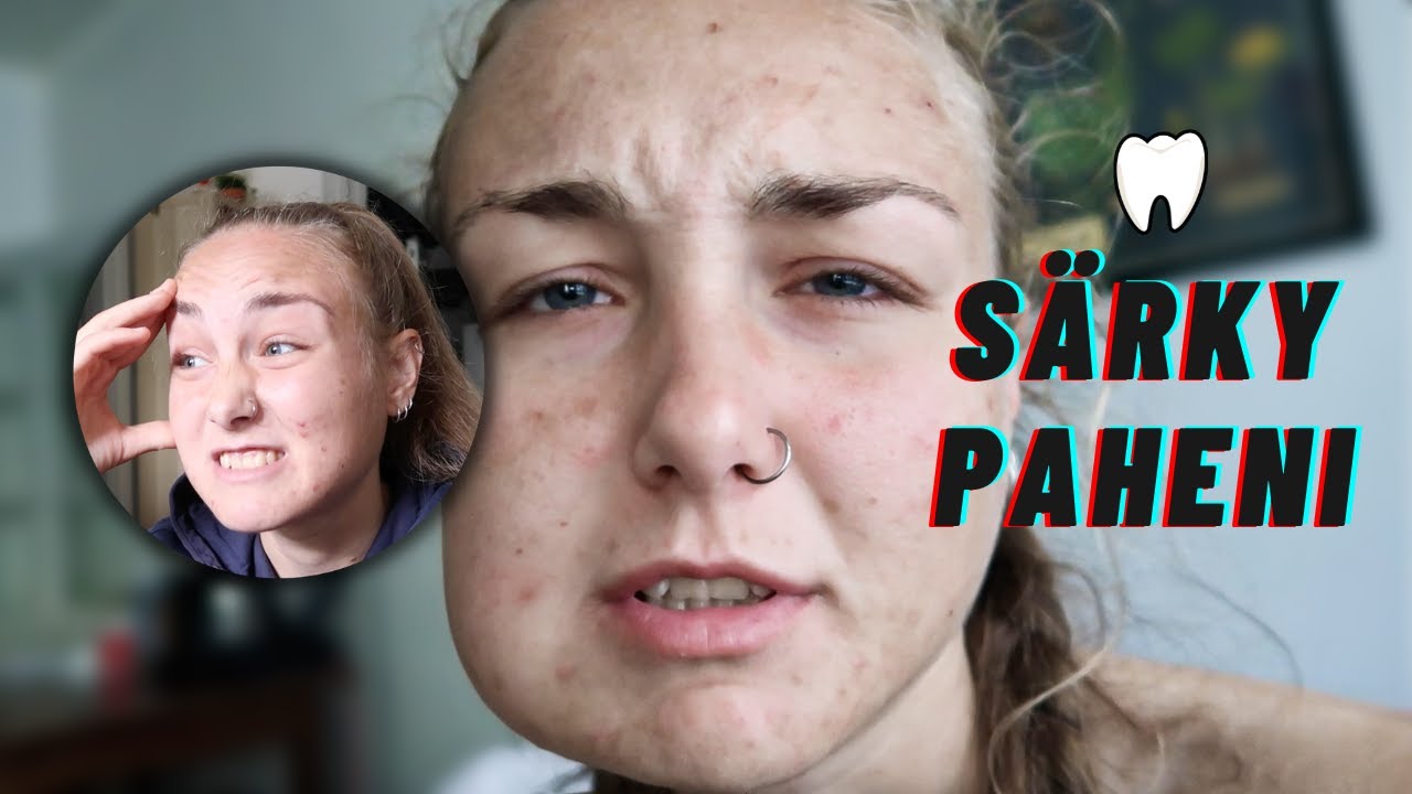 Viisaudenhampaiden poisto ja siitä toipuminen | OSA 2