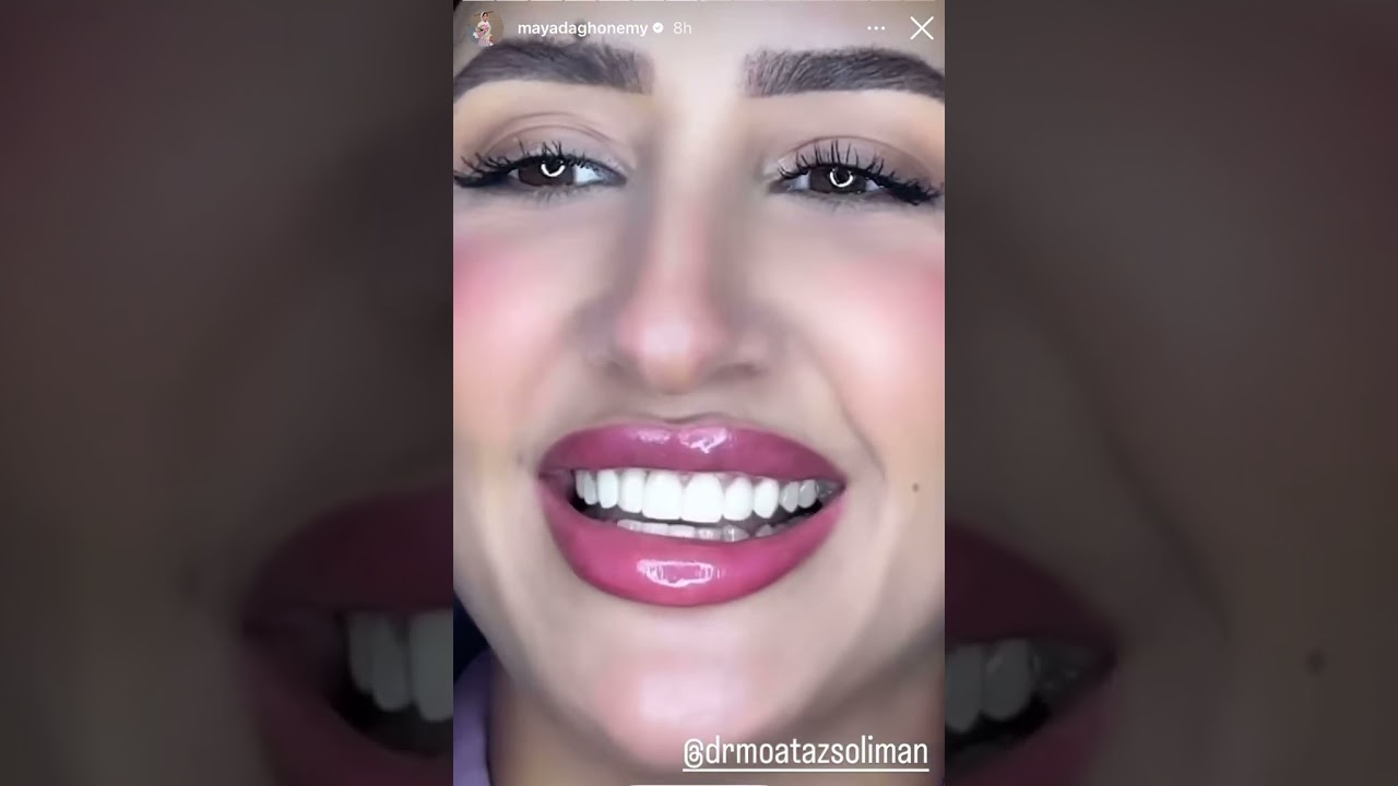 تجربة المشاهير زراعة وتجميل الاسنان مع د معتز سليمان