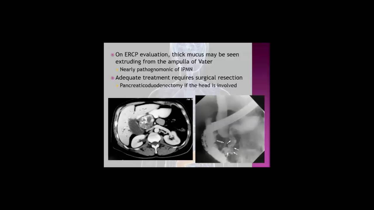 Pancreatic Cysts/Interventional EUS