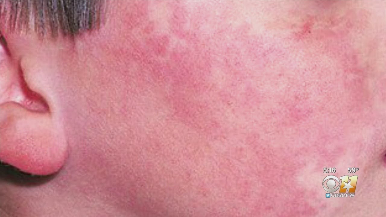 A 'Rash' Of Fifth Disease Making The Rounds In North Texas