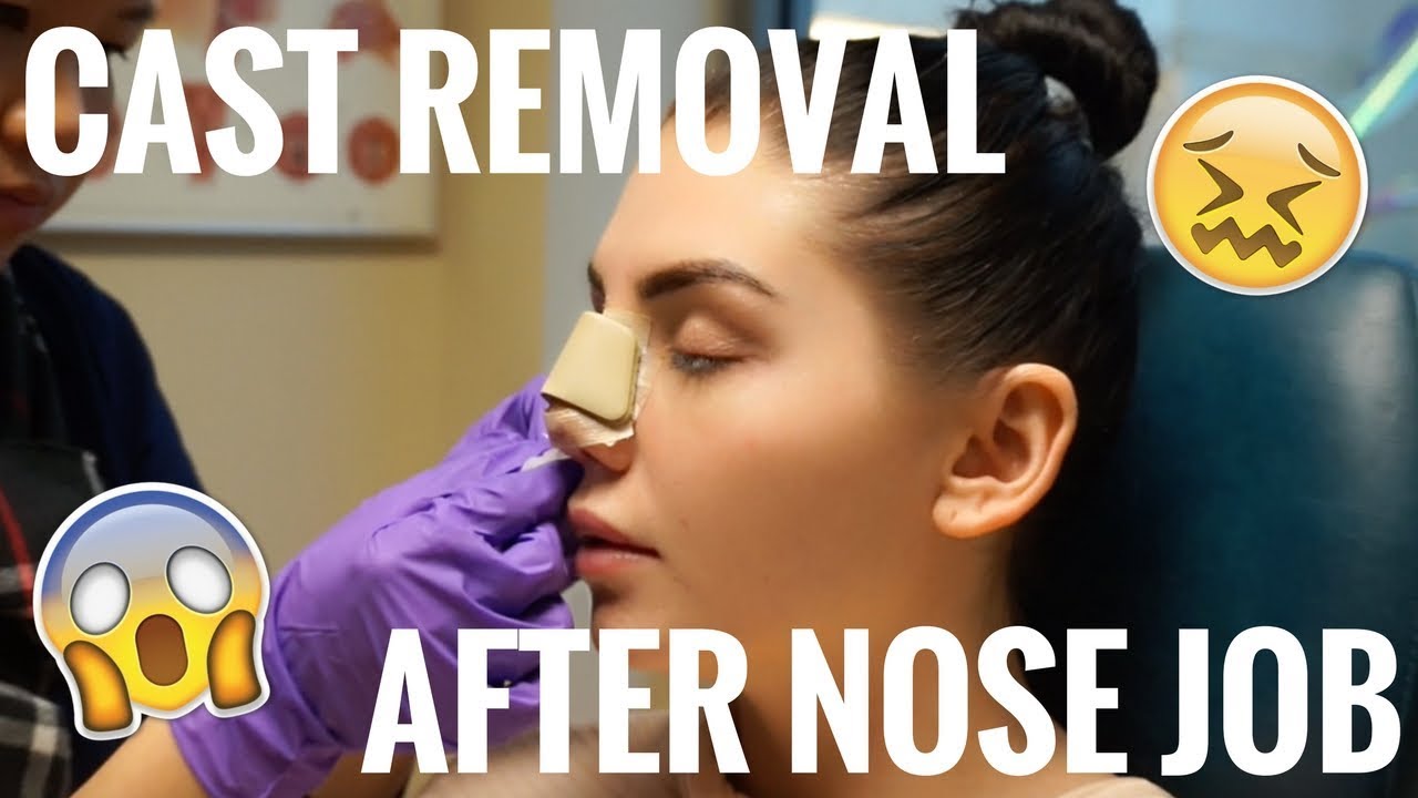 CAST REMOVAL *EMOTIONAL* | NOSE JOB EXPERIENCE | PT 4