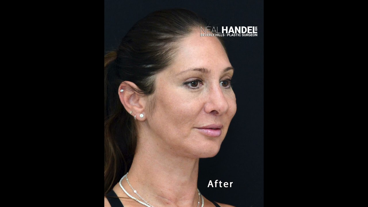 Beverly Hills Surgeon Dr. Neal Handel