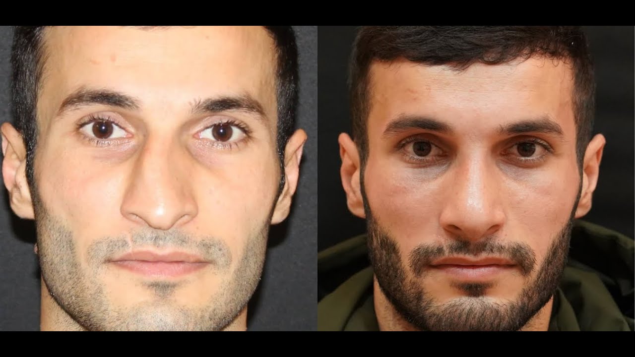 Rinoplastika(Burun Əməliyyatı)  | Dr.Sami Samin