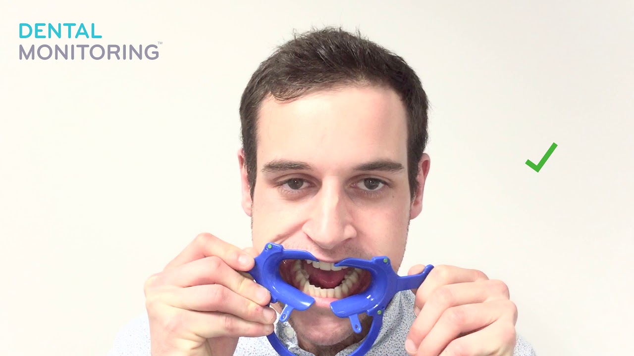 Dental Monitoring - How to put cheek retractors in