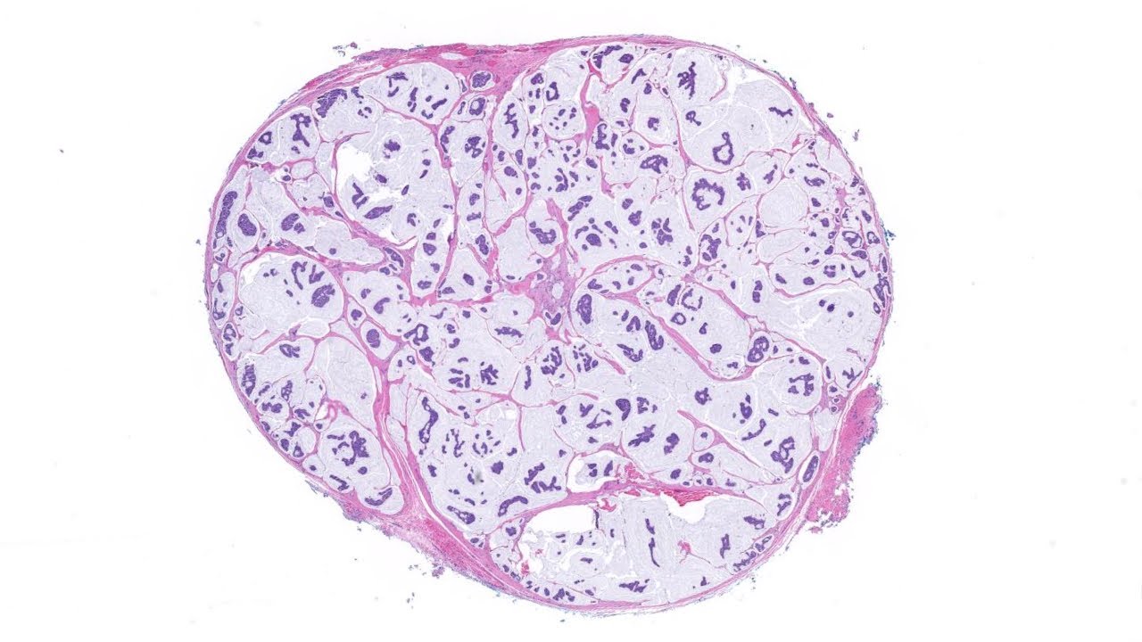 Mucinous carcinoma of skin - BEST EXAMPLE EVER! (AIP France 2021 - Bonus case) dermpath pathology