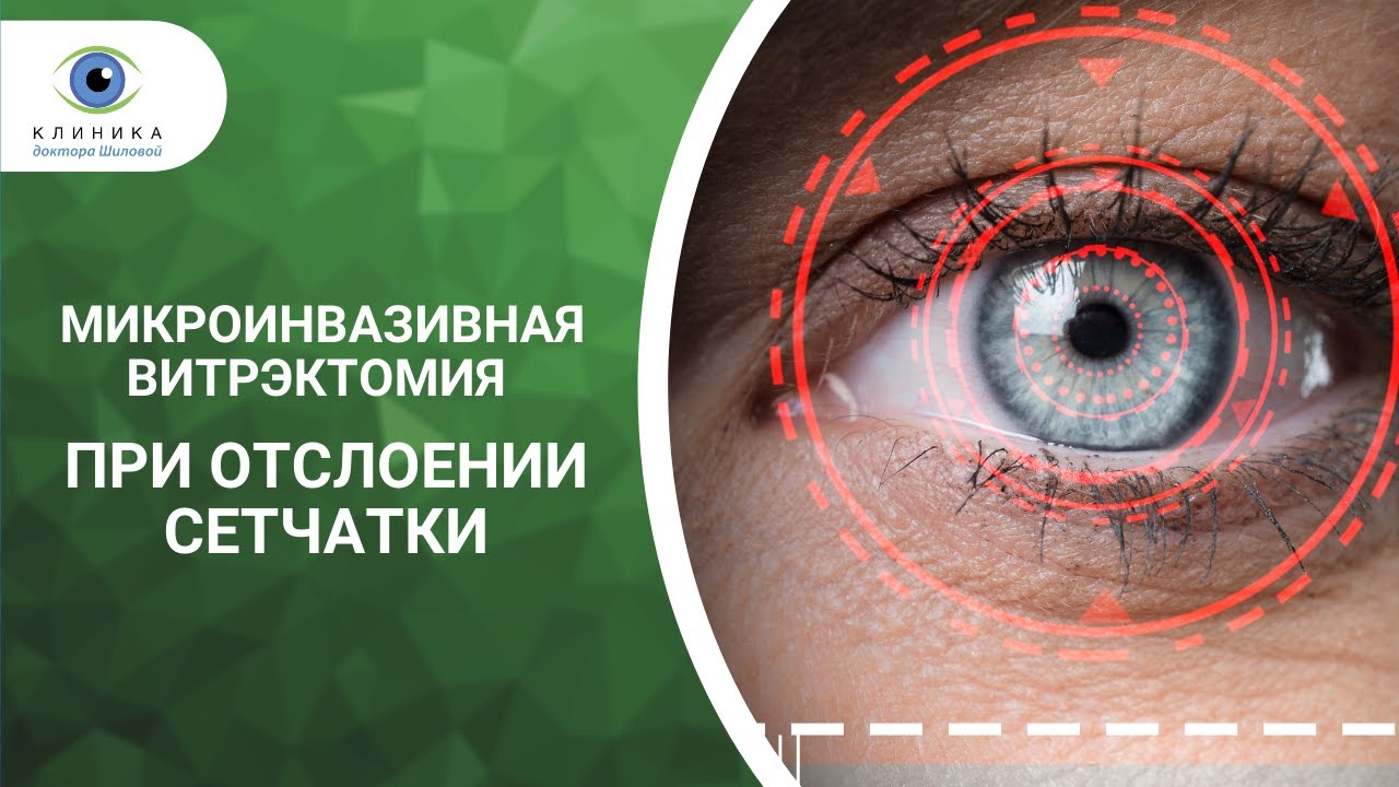 Микроинвазивная витрэктомия при отслоении сетчатки - видео операции