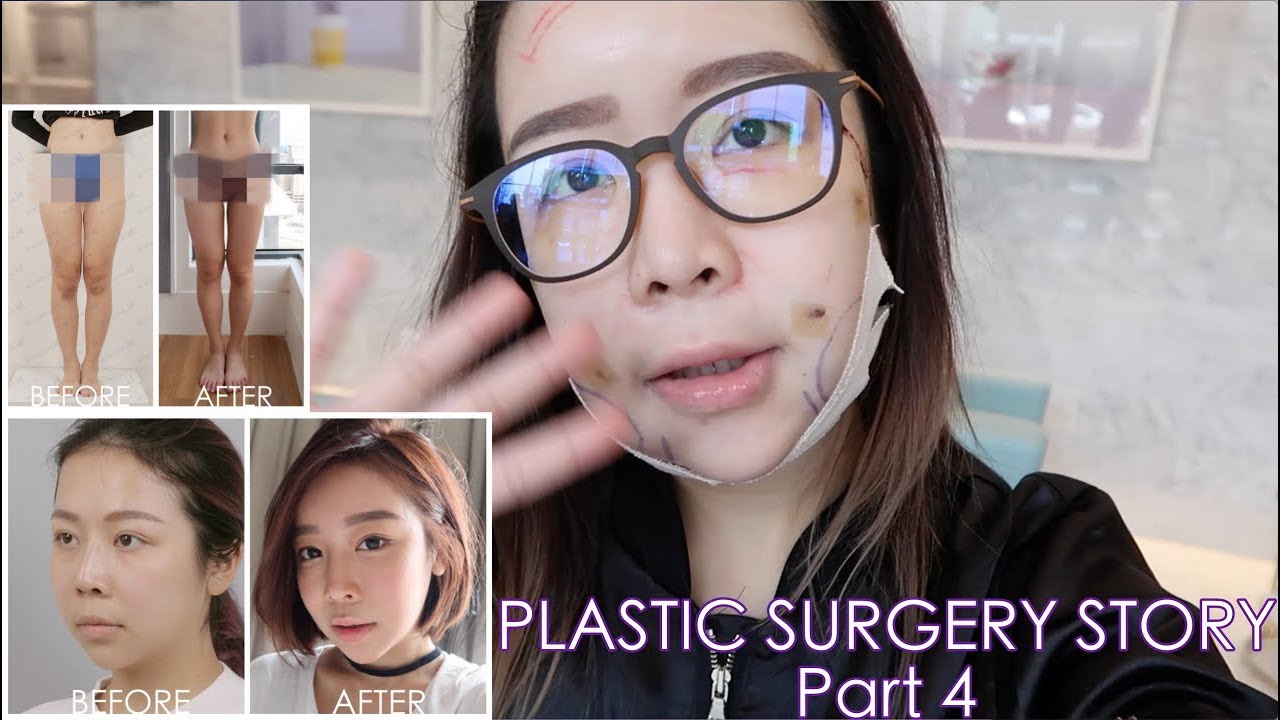 MY PLASTIC SURGERY STORY IN KOREA | Part 4