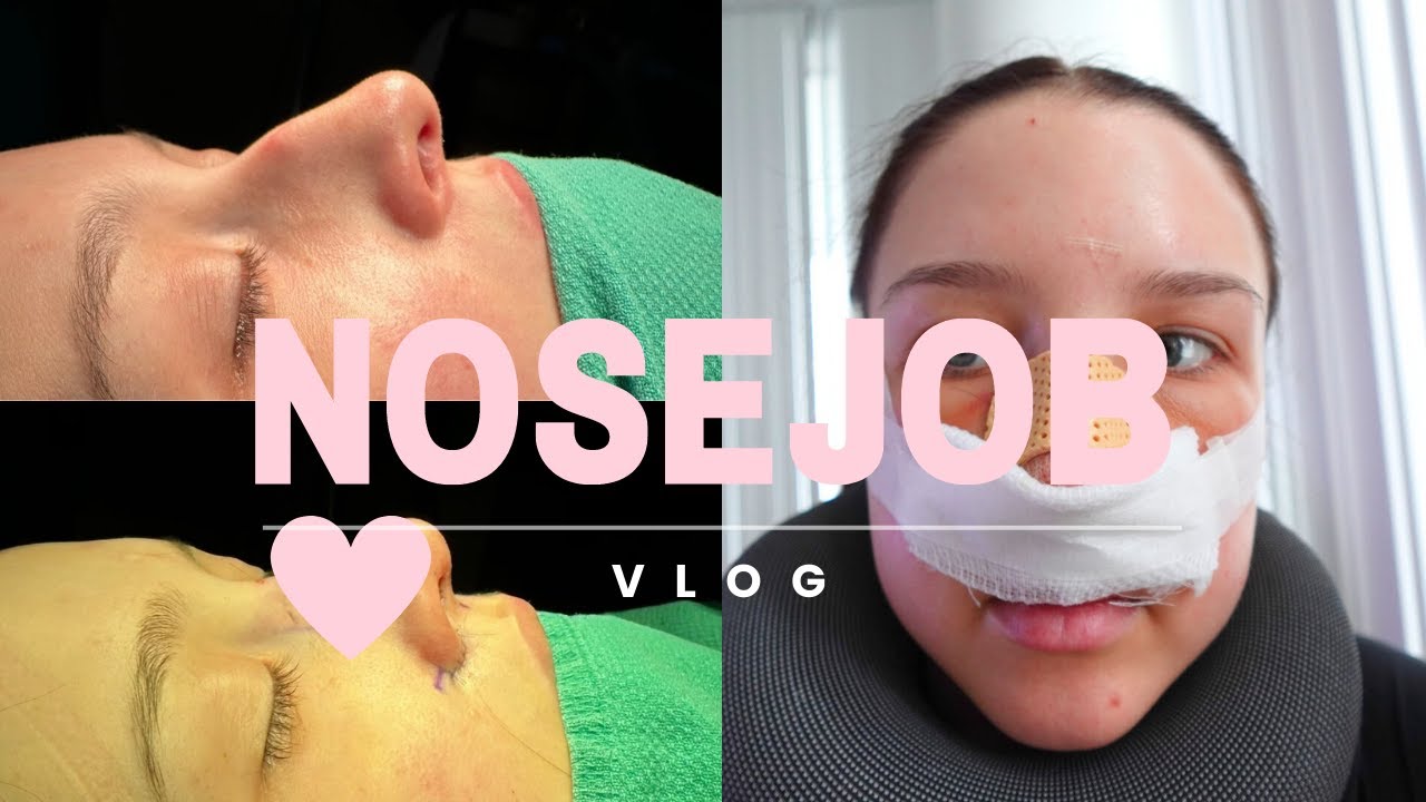 I GOT A NOSE JOB | RECOVERY & RESULTS - THE BEST SURGEON IN TORONTO