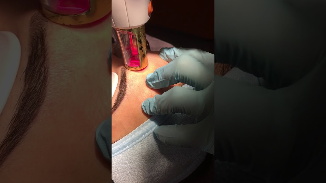 Fractionele laser bij health center betuwe voor littekens, rimpels