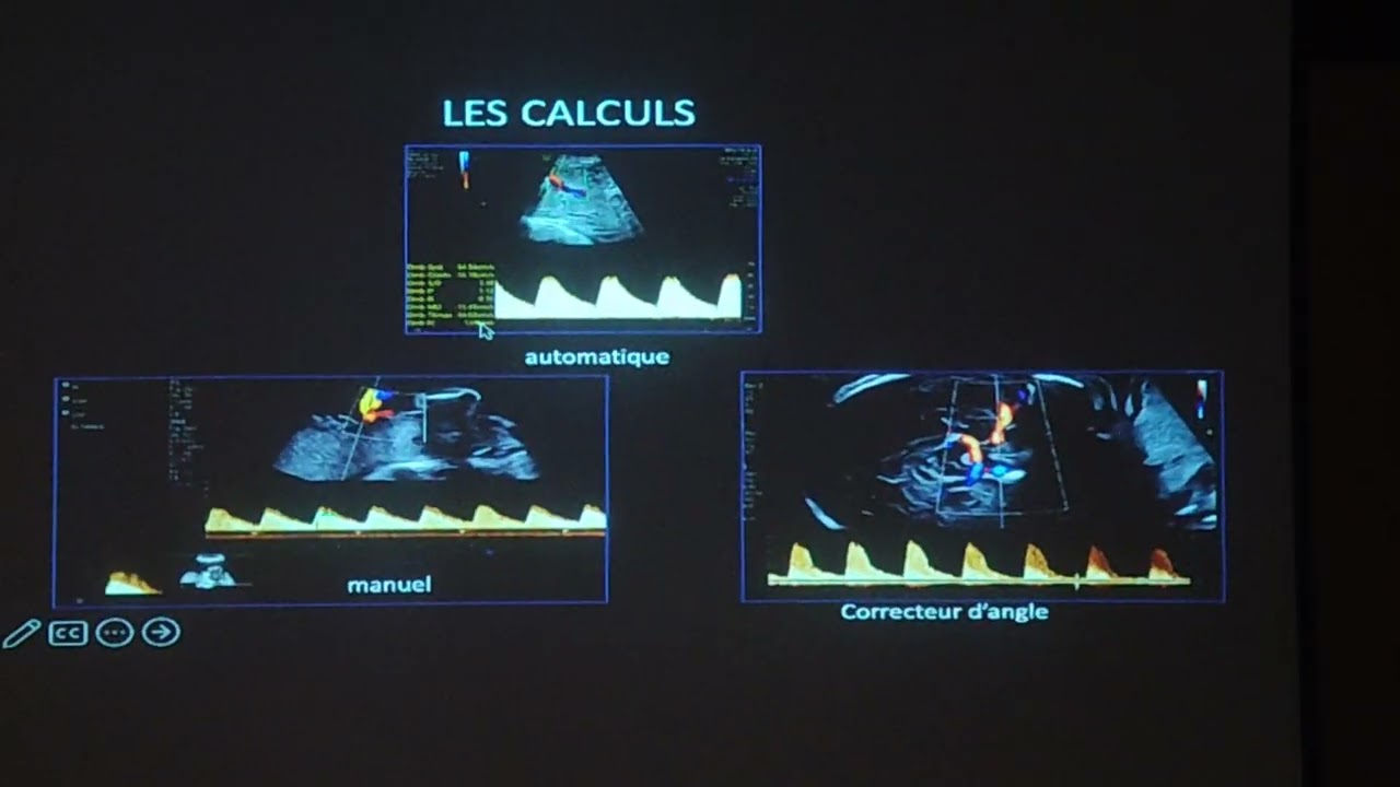 Doppler Dr Kabar 2ème partie