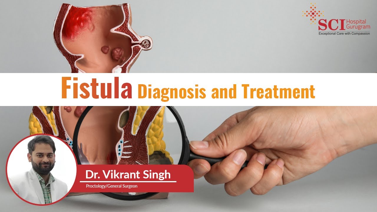 Fistula: Diagnosis & Treatment | Dr. Vikrant Singh | SCI Hospital