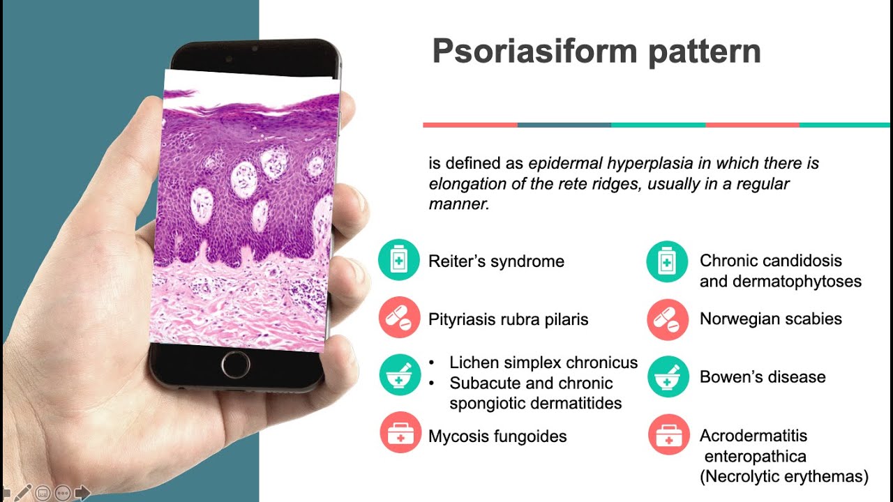 Dermatopathology; Psoriasiform reaction pattern