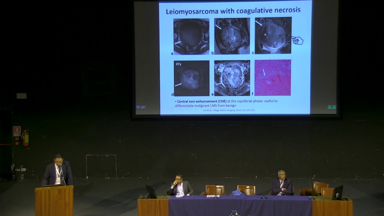 ‘Uterus: fibroid vs sarcoma’ delivered by Dr. Gigin Lin