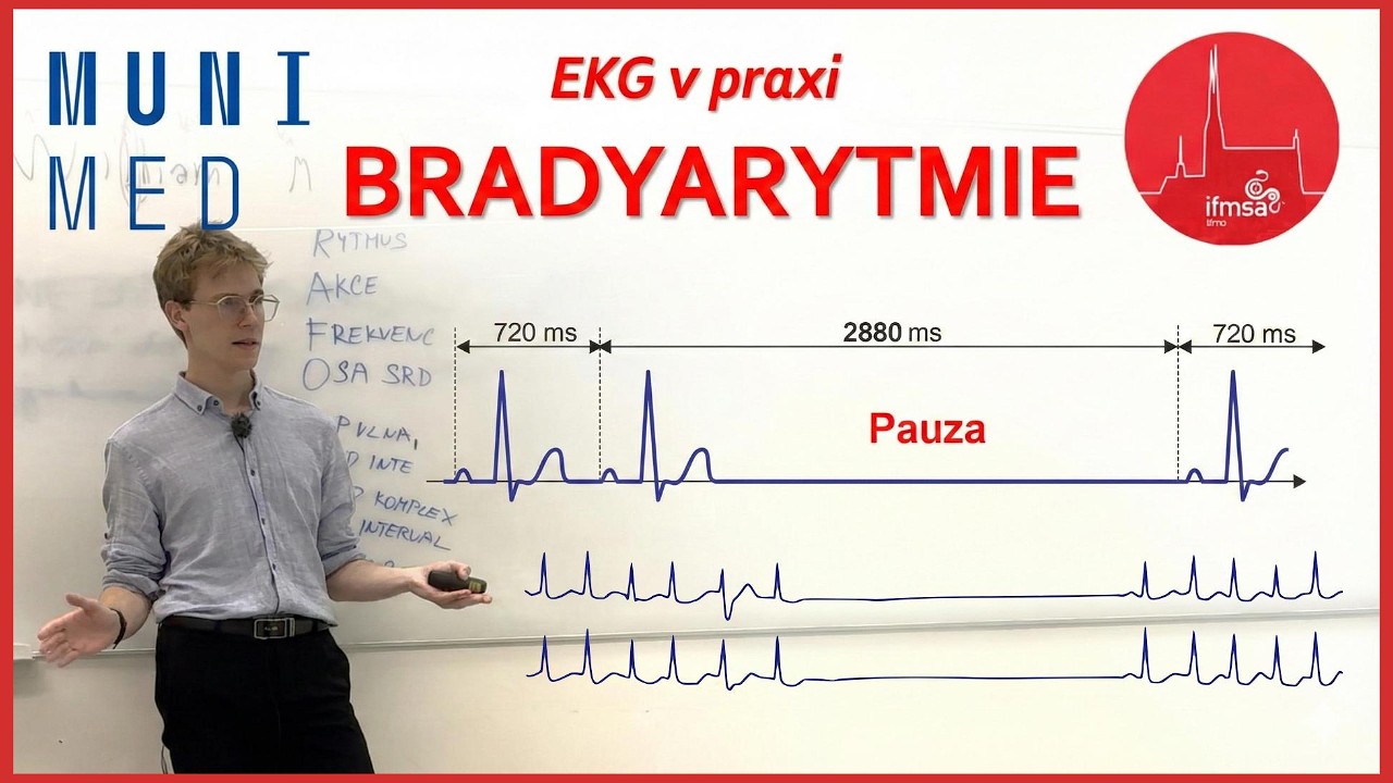 EKG bradyarytmie (rozšírenie) | SA bloky, sinus arrest, SSS