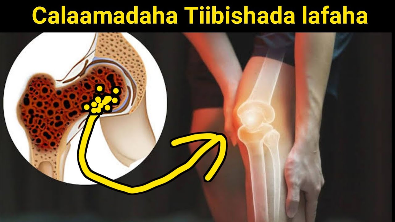 tiibishada lafaha iyo Lafa xanuunka xiriirka ka dhaxeeyo iyo calaamadaha lagu garto tibishada lafaha