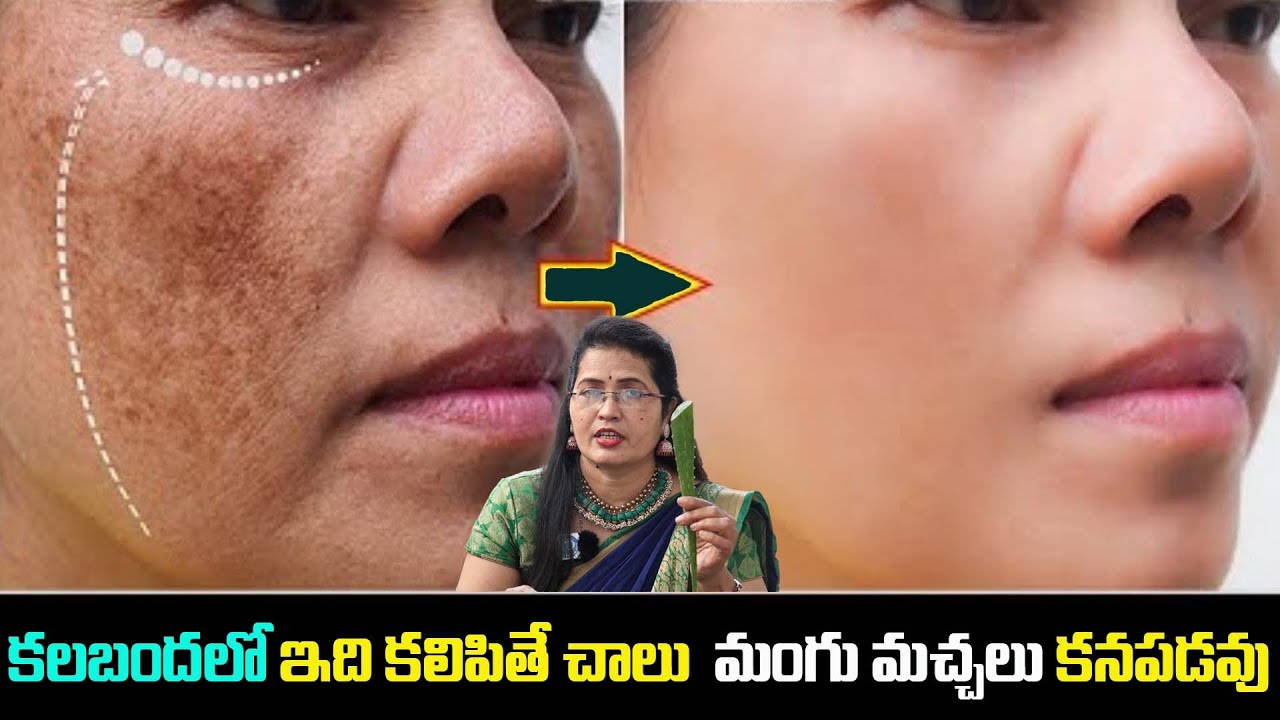 కొంచెం తేనే కొంచెం కలబంద మంగు మచ్చలు ఉండనే ఉండవు | Remove Face Pigmentation Naturally | Shobha Rani