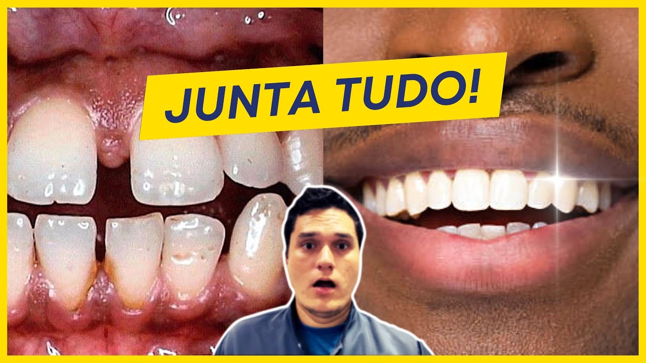 DIASTEMAS, COMO CORRIGIR? | 3 ALTERNATIVAS PRA RESOLVER DE VEZ!