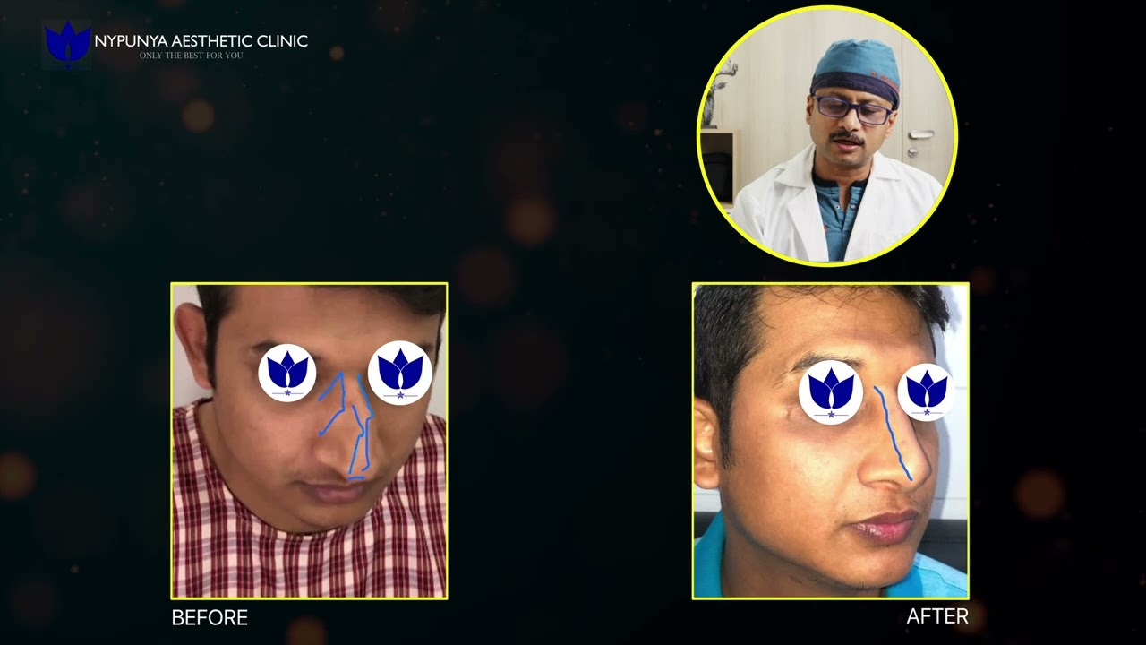 From North India to Bangalore for the Perfect Nose &ndash; You Won't Believe the Results!