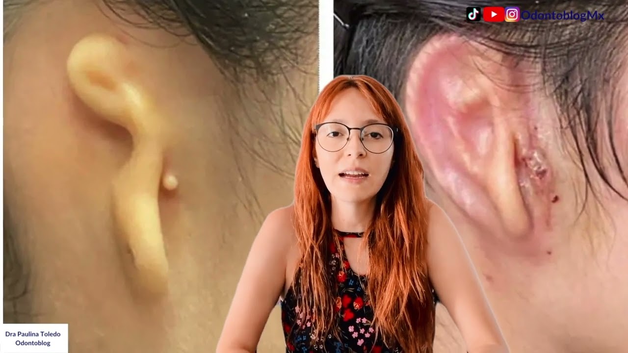NOTICIA:  Implantan la primera oreja impresa en 3D con células humanas