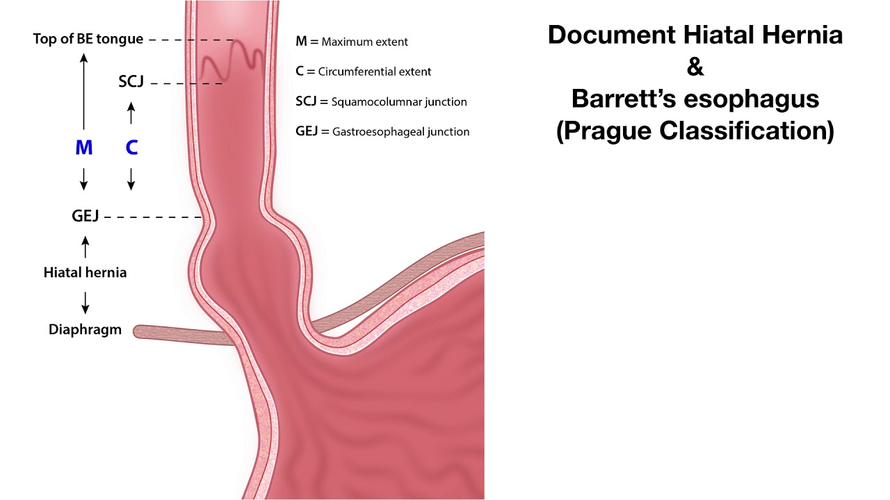 Barrett's esophagus - Prague Classification - Graphic Illustration