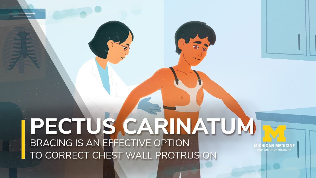 Как медицина штата Мичиган лечит Pectus Carinatum