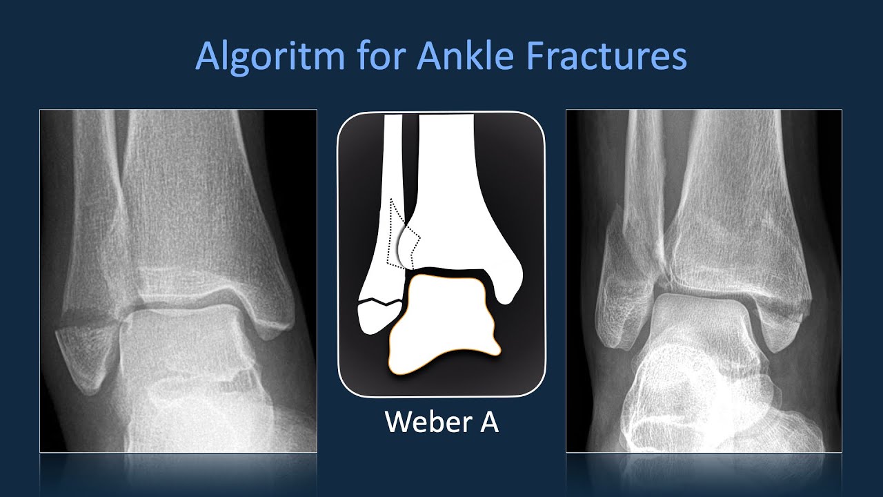 Algoritm for Ankle Fractures