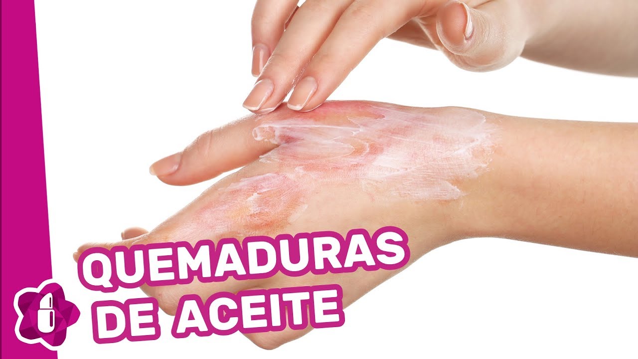 Cómo curar las quemaduras de aceite