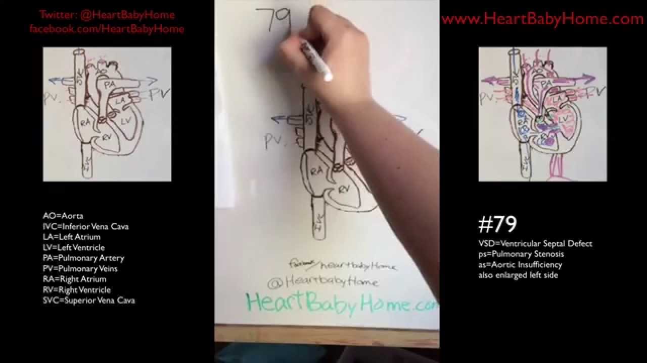 Heart Defect #79 - VSD, ps, as, enlarged left