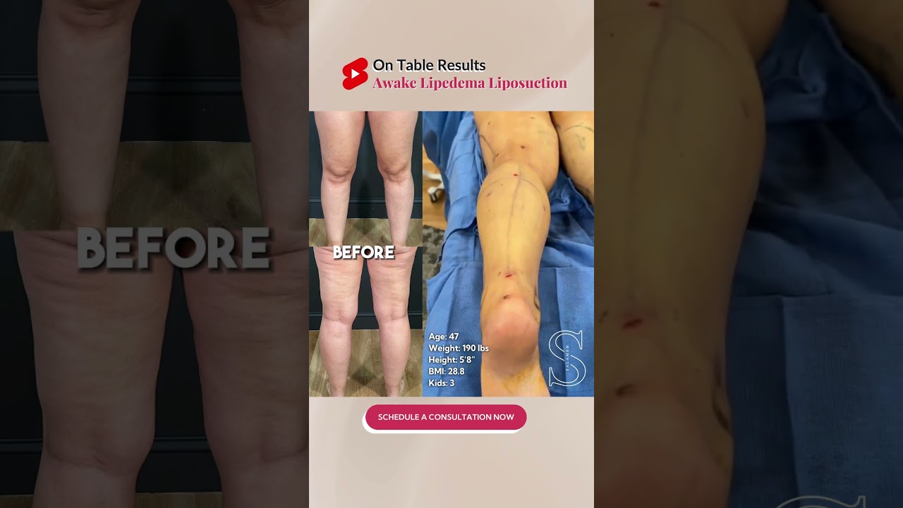 Check out these amazing on-table results for Awake Lipedema Liposuction! 😍