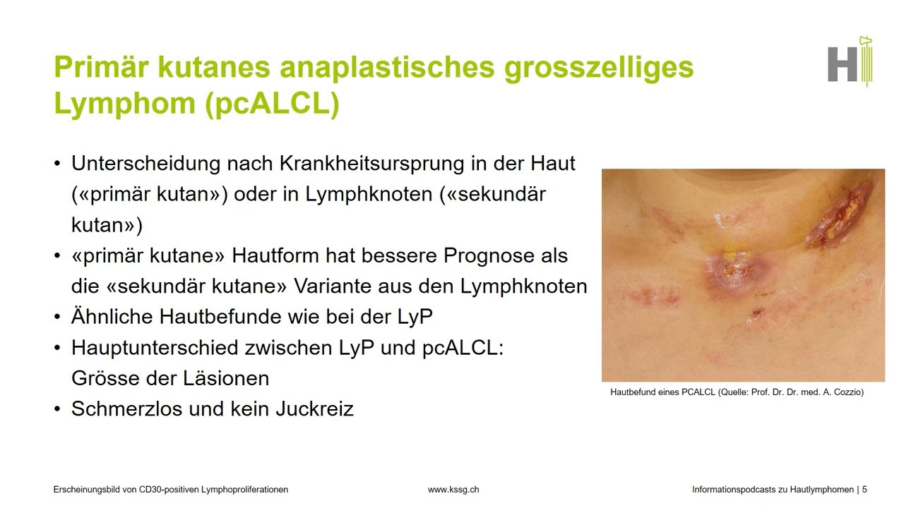 5. Erscheinungsbild von CD30-positiven Lymphoproliferationen – Präsentationsreihe zu Hautlymphomen