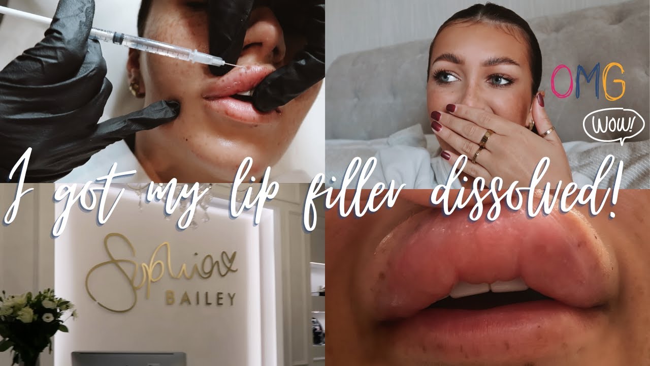 I GOT MY LIP FILLER COMPLETELY DISSOLVED! Asher Mary-Lou
