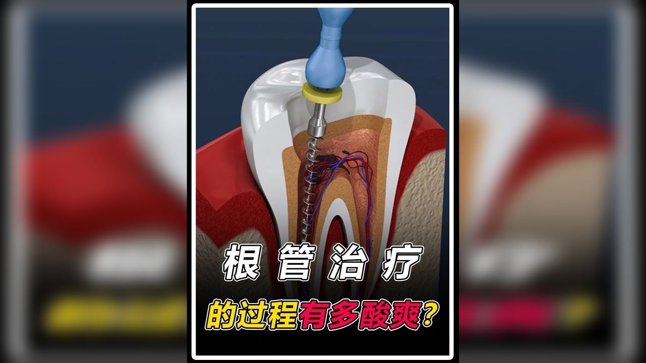 你知道根管治疗有多酸爽吗？一颗烂牙是怎么被修复的？