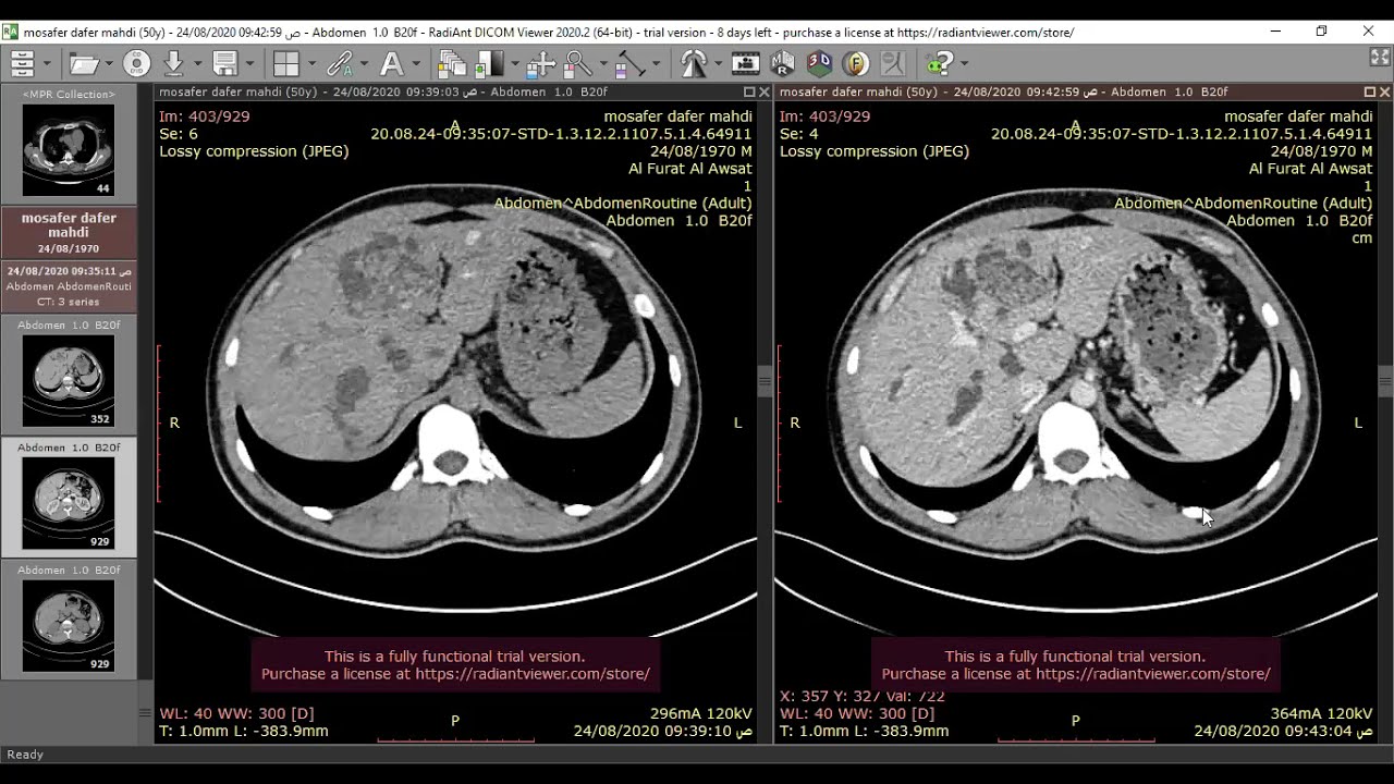Caroli disease