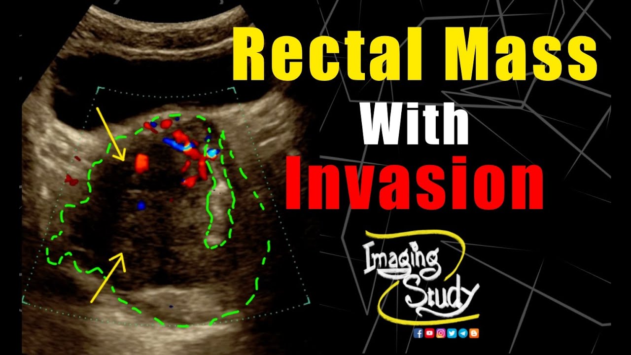 Rectal Malignant Mass with Invasion || Ultrasound || Doppler || Case 284