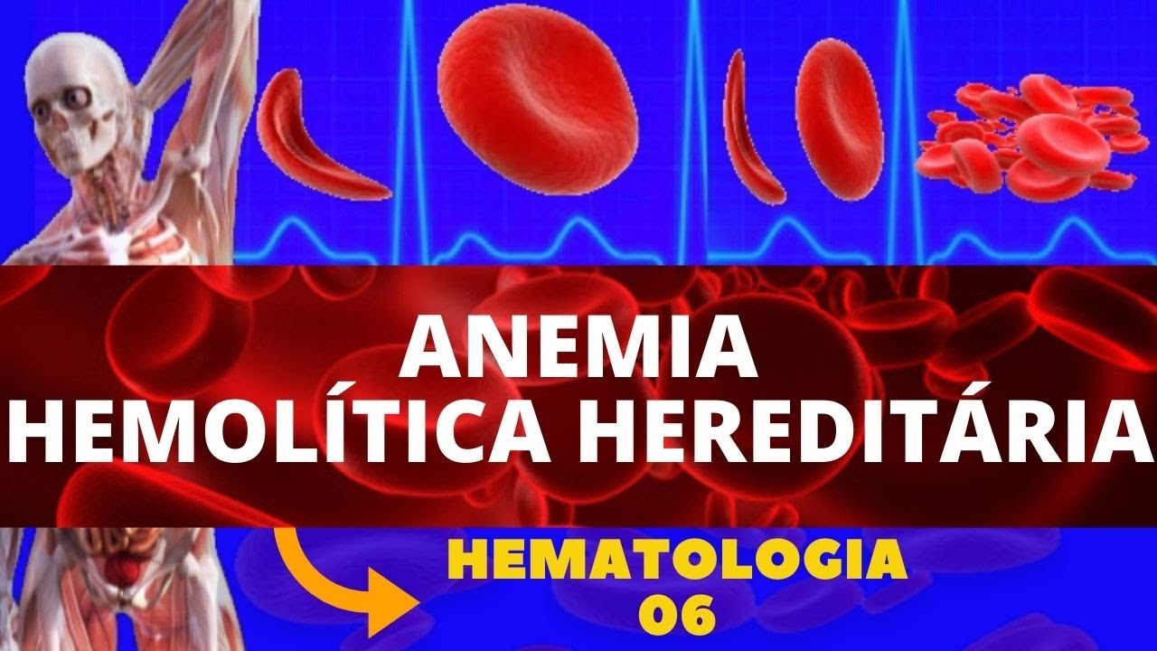 ANEMIA HEMOLÍTICA HEREDITÁRIA - HEMATOLOGIA (ESTUDO DAS ANEMIAS)