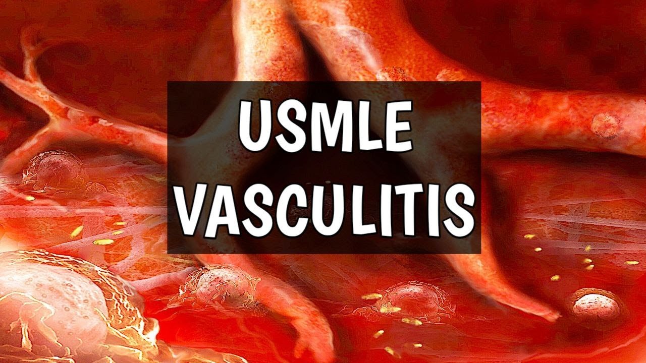 FULL Vasculitis REVIEW  مراجعة لموضوع الالتهاب الوعائي