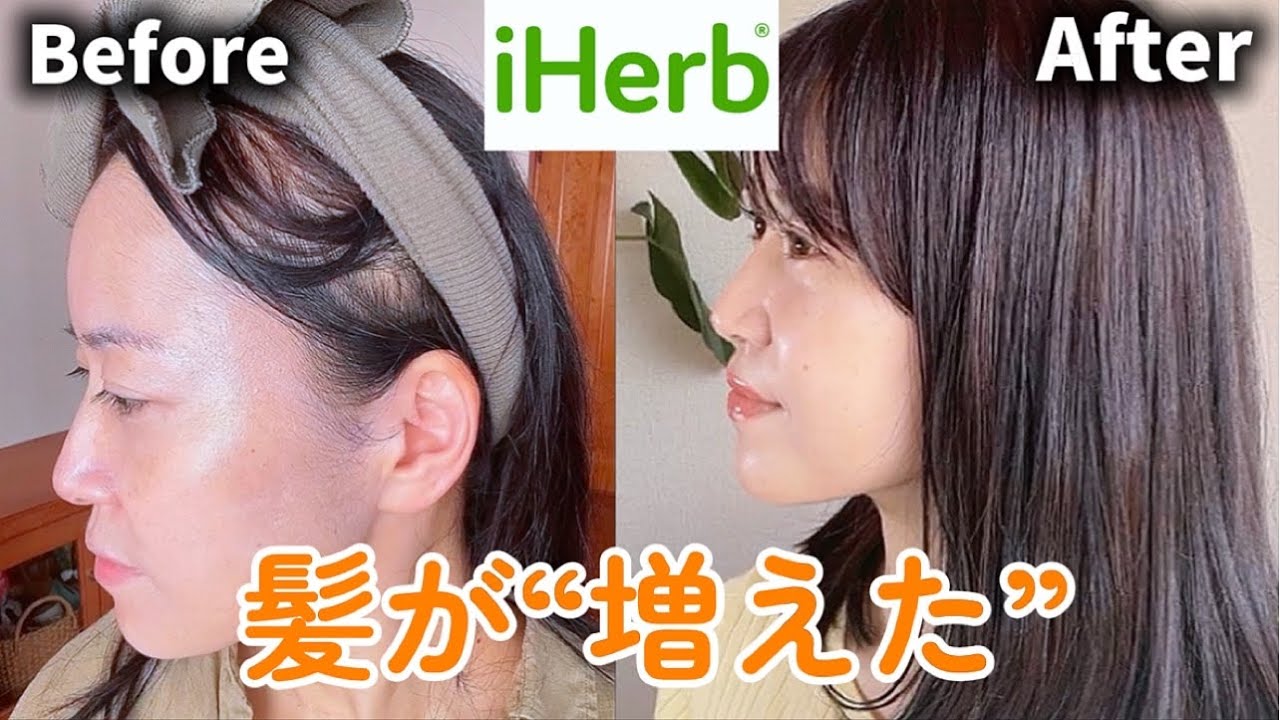 【iHerb】半年で髪が増えた！増毛、育毛アイテムの経過報告🌿