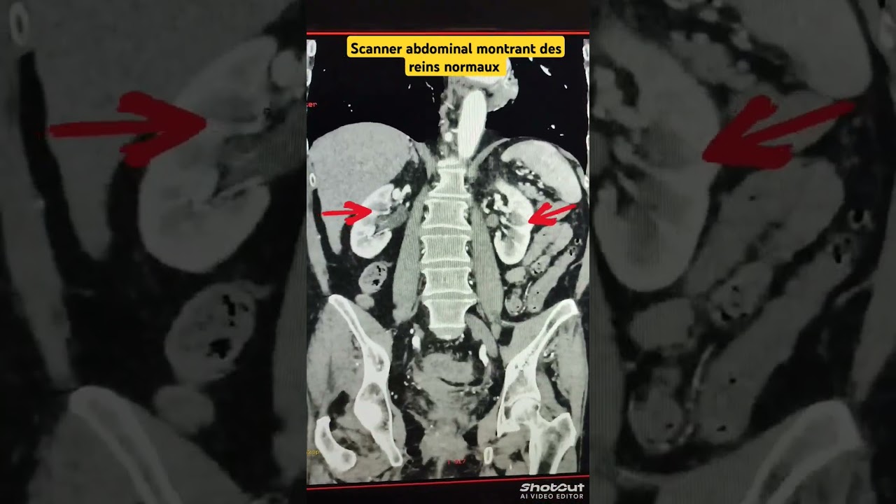Scanner abdominal#radiologie#radiologue #manipradio #pourtoi