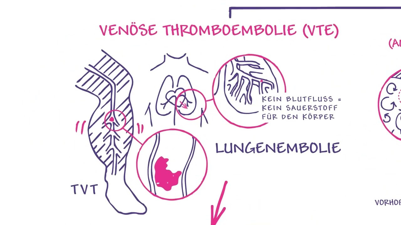 Tiefe Venen-Thrombose, Vorhofflimmern, Akutes Koronarsyndrom – Blutgerinnsel und möglichen Folgen