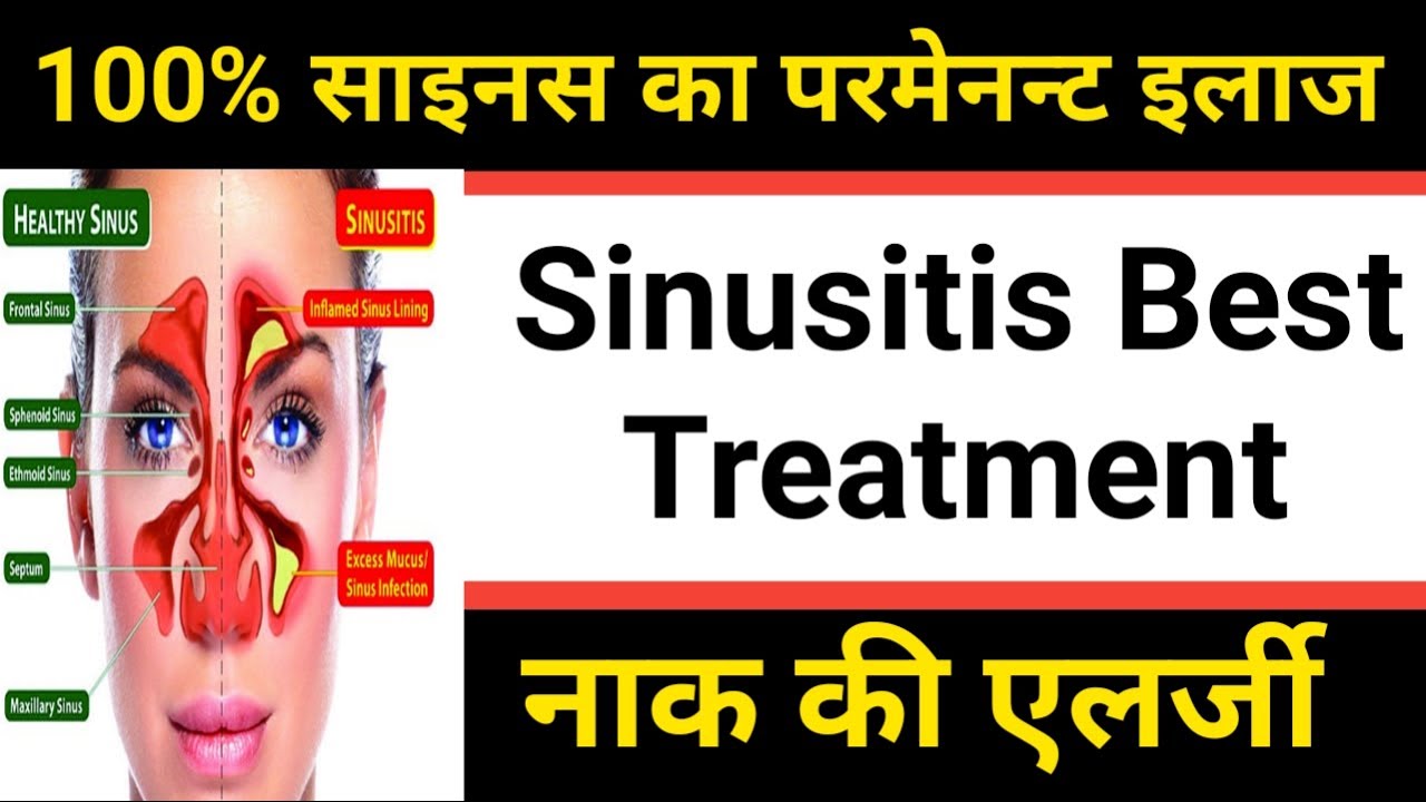 Sinusitis परमानेंट इलाज - Sinusitis Treatment | Sinusitis Treatment In Hindi | Sinusitis Homeopathic